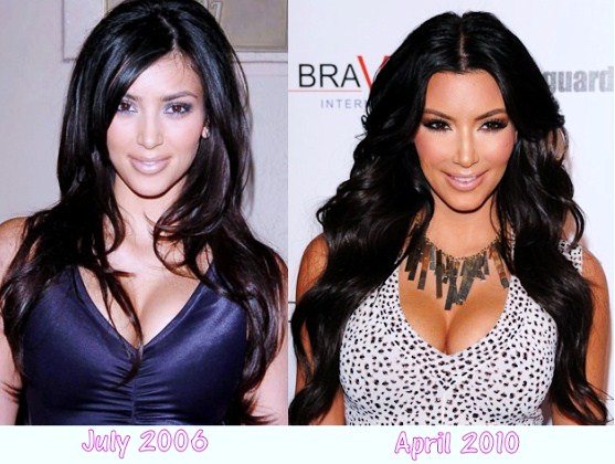 kim kardashian plastic surgery before and after photos. Kim Kardashian plastic surgery